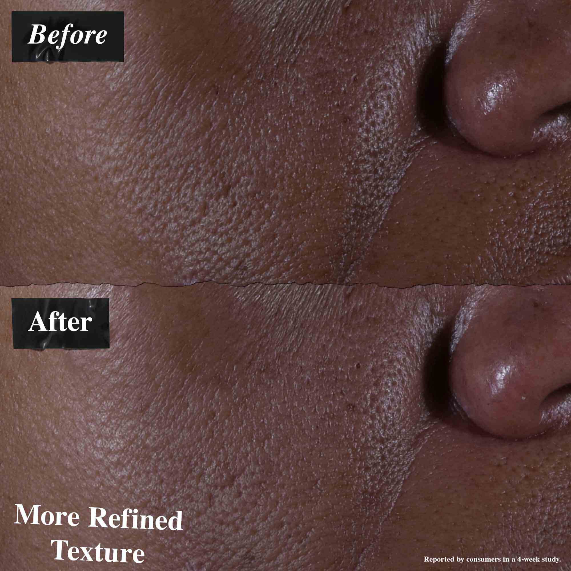 Előtte-utana osszehasonlitas, amely az Ultra Pure 9.8% Glycolic Acid Serum-mal kezelt bőrt mutatja. Az „előtte” kep egyenetlen texturat, mig az „utana” kep finomabb texturat mutat.