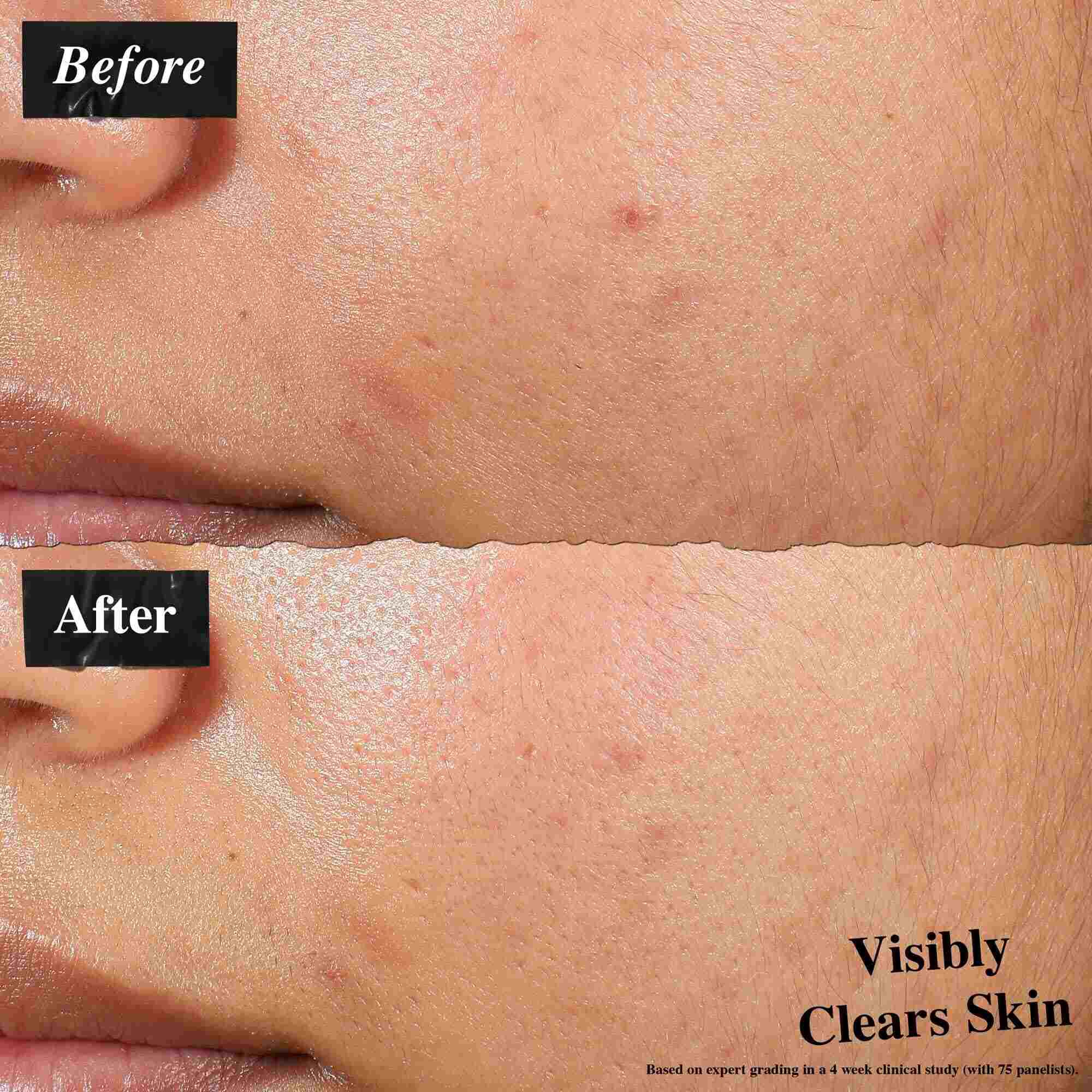 Előtte-utana osszehasonlitas, amely az Expertly Clear Blemish-Treating & Preventing Lotion-nel kezelt bőrt mutatja. Az „előtte” kep bőrhibakat es egyenetlen texturat, mig az „utana” kep lathatoan tisztabb bőrt mutat.