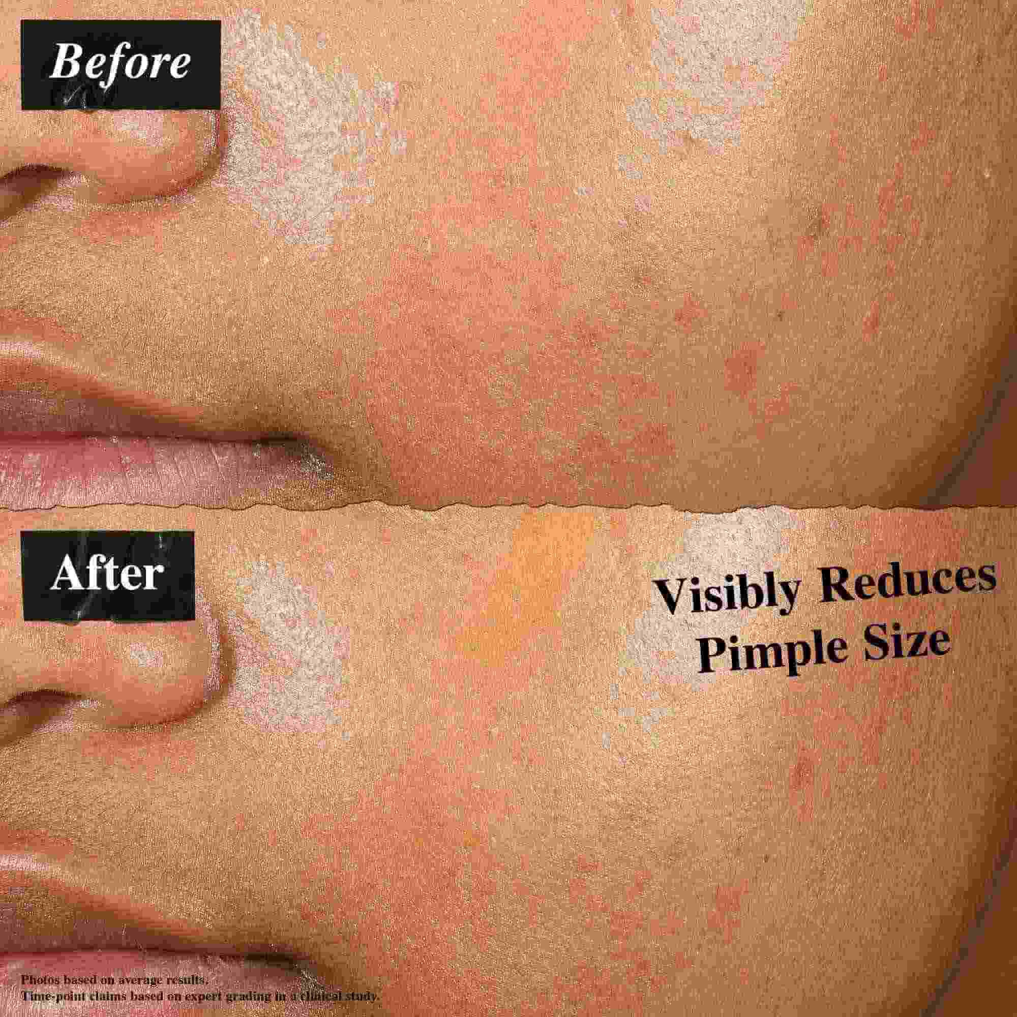 Előtte-utana osszehasonlitas, amely a Truly-Targeted Blemish-Clearing Solution-nel kezelt bőrt mutatja. Az "előtte" kep lathato pattanasokat mutat, mig az "utana" kep csokkent pattanasmeretet.