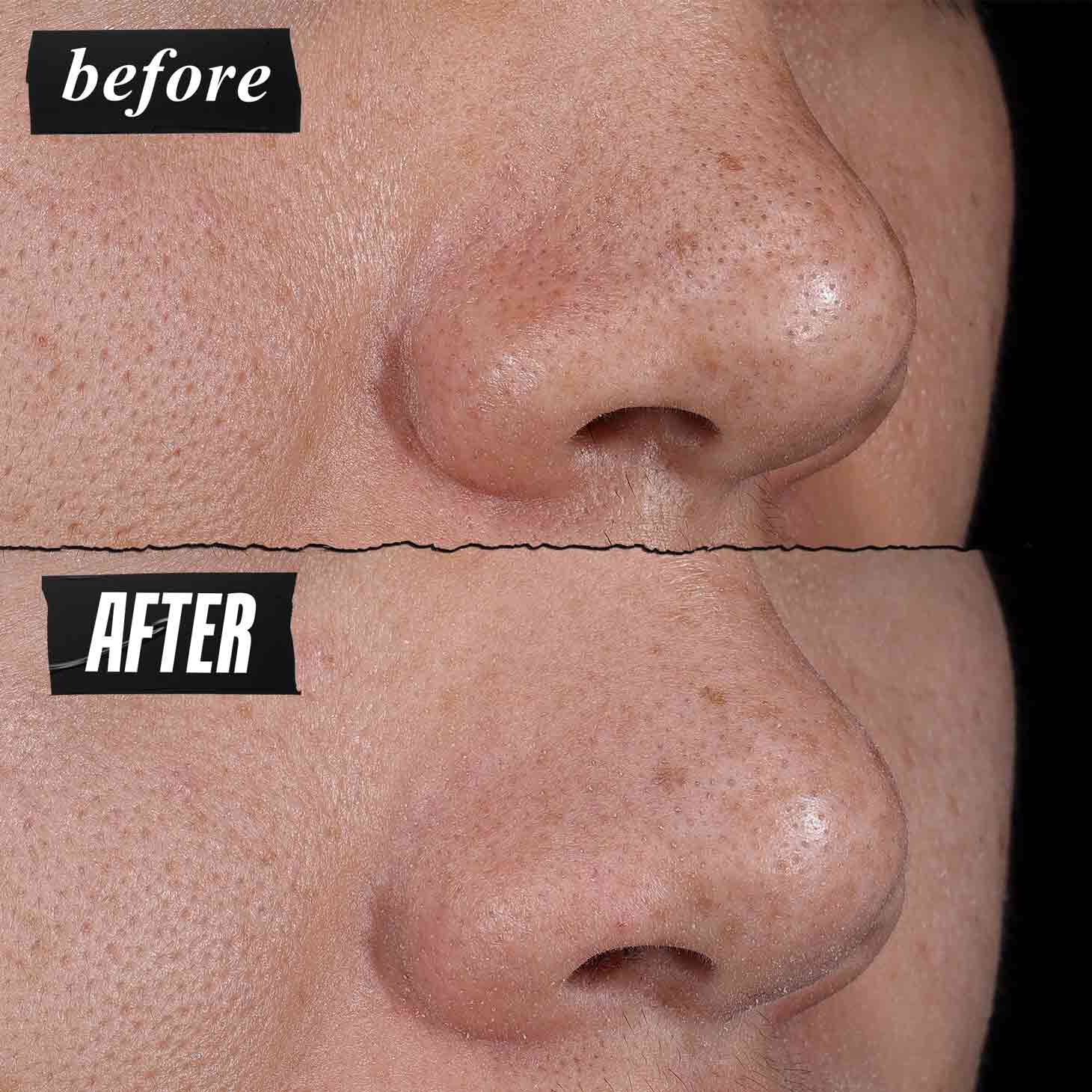 Előtte-utana foto – a Kiehl's Rare Earth Deep Pore Cleansing Masque lathatoan csokkenti a porusokat