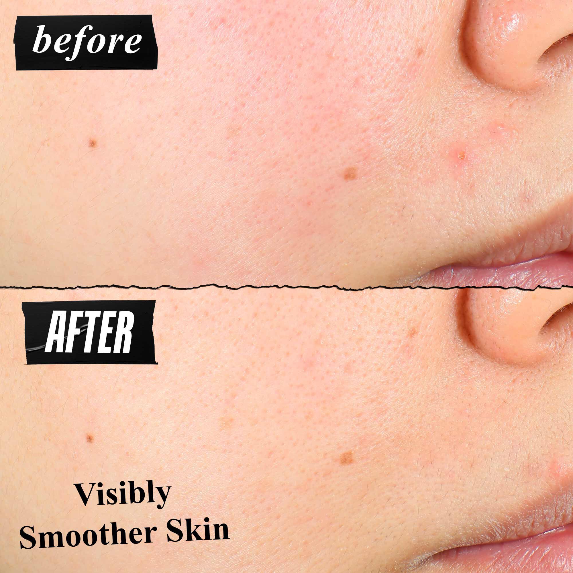 Bőrtextura előtte-utana osszehasonlitasa, amely lathatoan simabb bőrt mutat hasznalat utan.