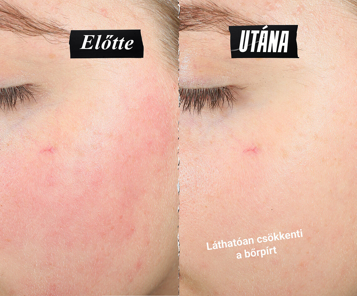 A bőr csokkent bőrpirjat mutato osszehasonlitas. A szoveg felirata: Lathatoan csokkenti a bőrpirt.