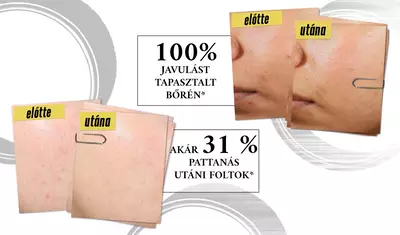 Comparison image showing before and after results of acne treatment. The "before" photos display skin with blemishes, while the "after" photos show clearer skin, highlighting 100% of users experienced acne clearing and a 31% reduction in post-blemish marks.